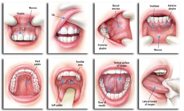 oral cancer screening albertville