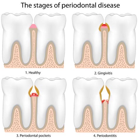 periodontal disease therapy