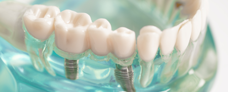 implant dentures