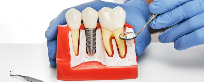 missing tooth solution